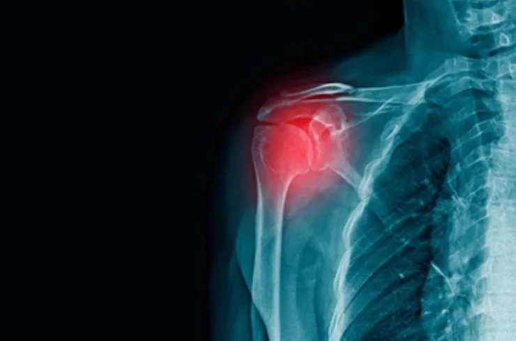 X-Ray------11